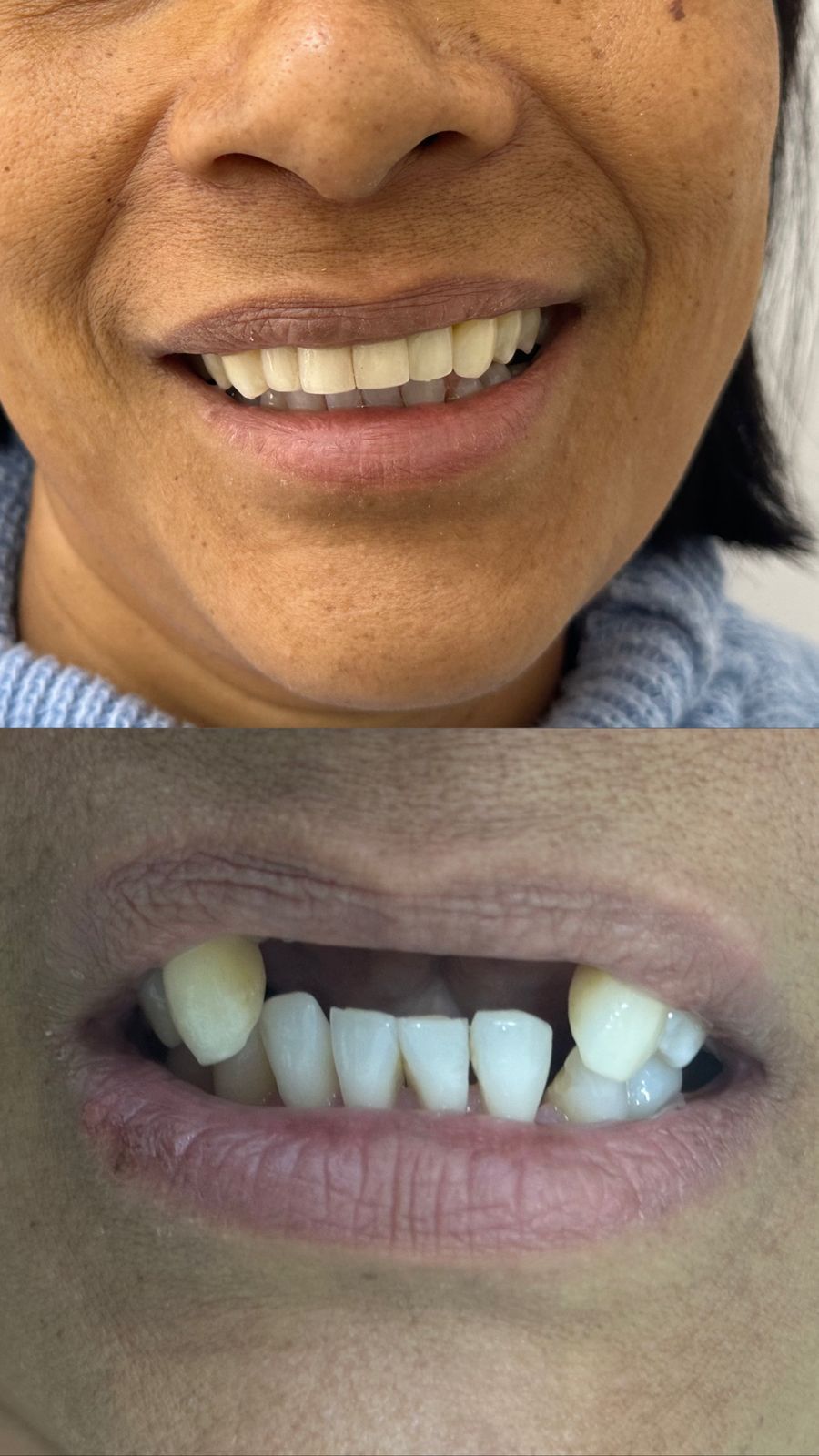 Múltiplos implantes