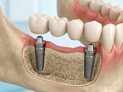 Múltiplos Implantes